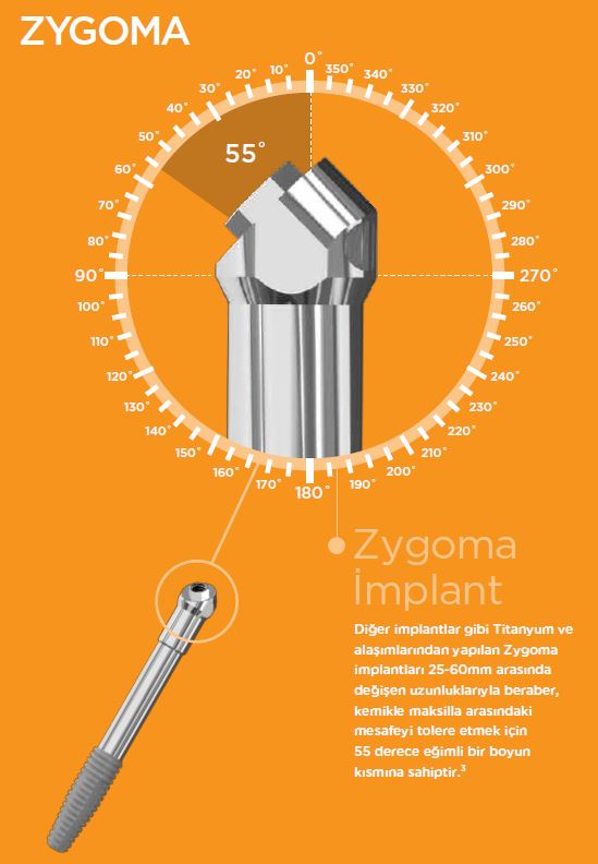 Zigoma İmplant Nedir?