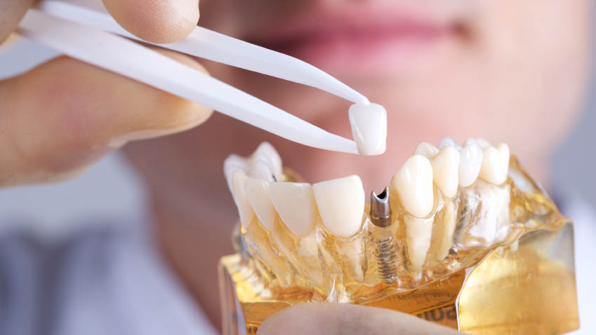 İmplant Sonrası Şişlik ve Ağrı